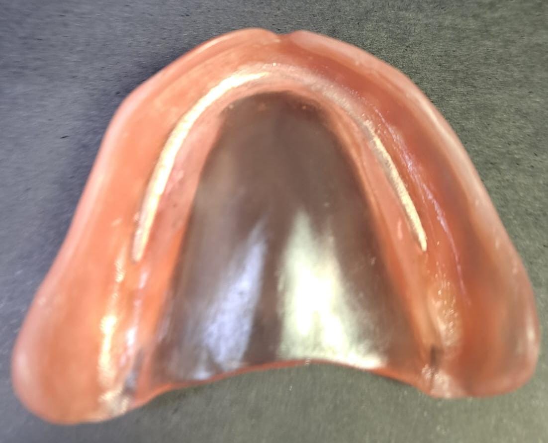 O reforço metálico só pode ser visto pelo paciente, ele não aparece nem área vestibular e tbém na palatina e lingual.