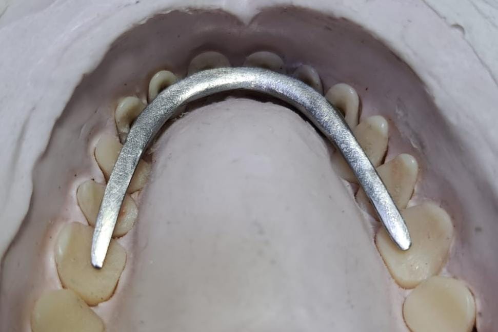 Barra metálica com 6 pinos que penetram os dentes anteriores de caninos a canino.
