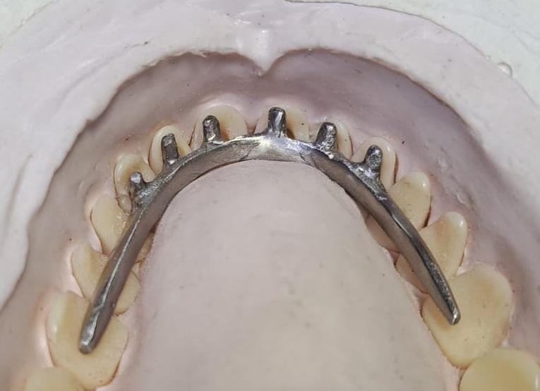 Barra metálica com 6 pinos que penetram os dentes anteriores de caninos a canino.