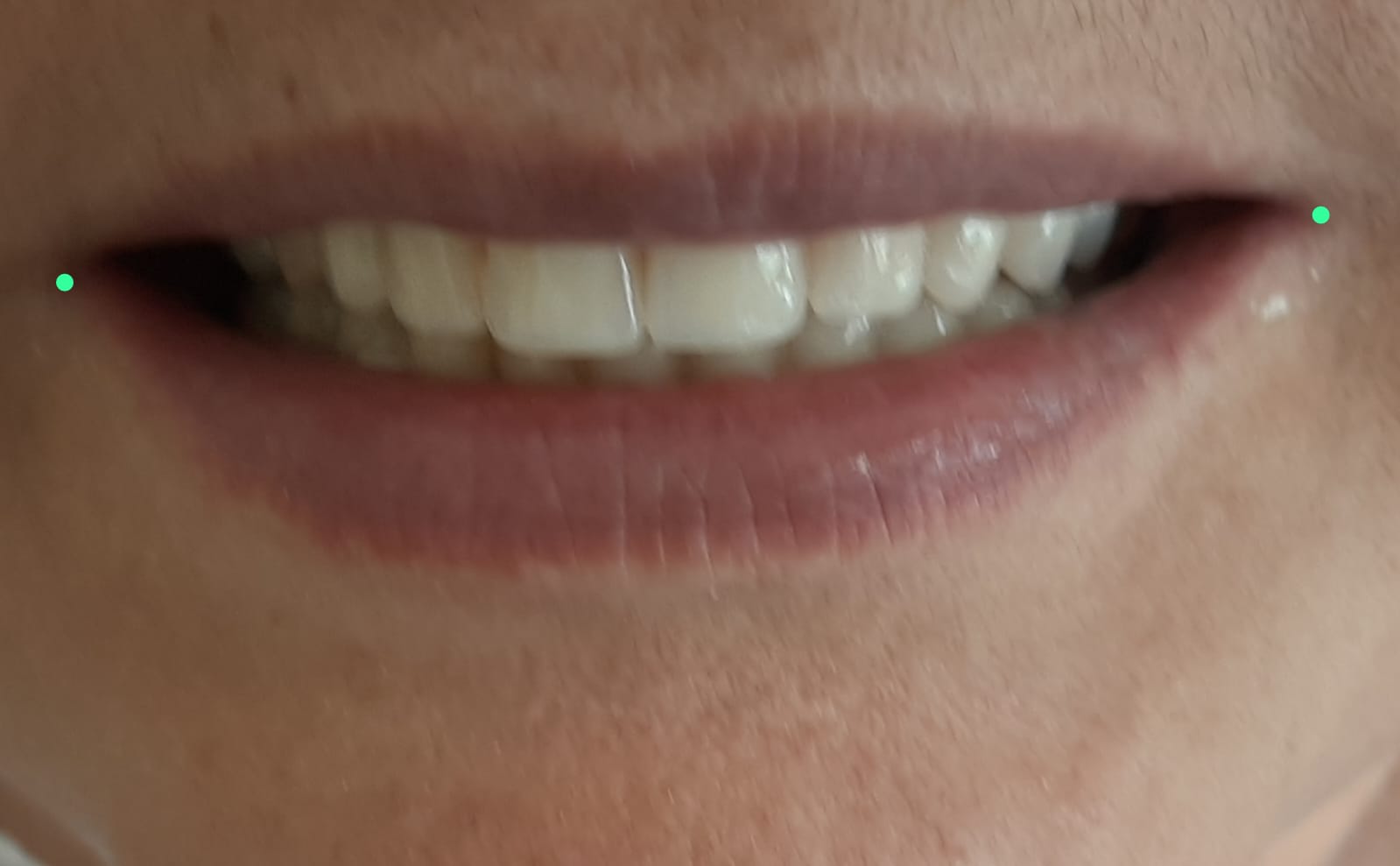 O corredor bucal adequado contribui para a harmonia do sorriso e a trituração dos alimentos.