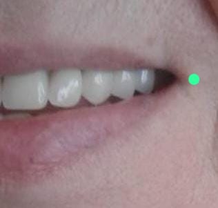 O corredor bucal é o espaço entre a face vestibular dos dentes posteriores e a mucosa interna da bochecha.