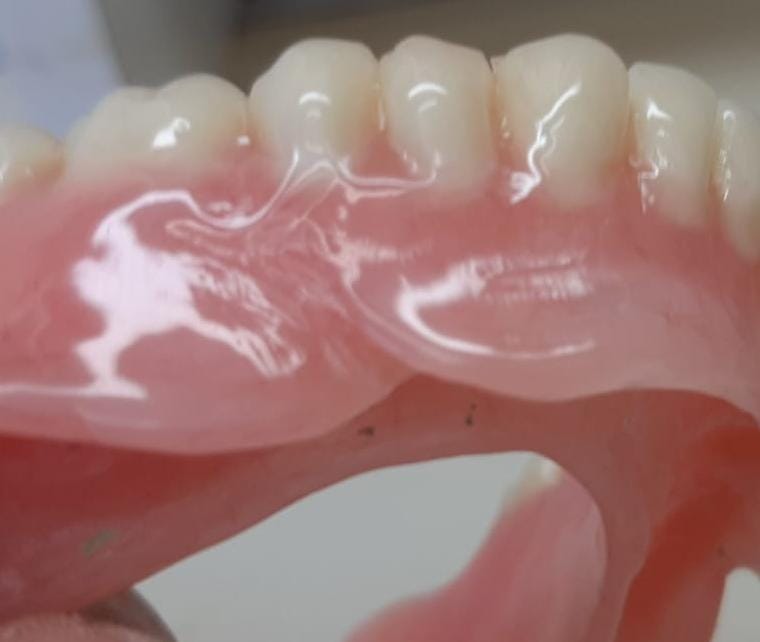 Bridas são dobras do tecido mole localizadas lateralmente na boca, que podem interferir na higienização, fonética, estética e estabilidade da prótese. Fazemos os alojamentos para as bridas.